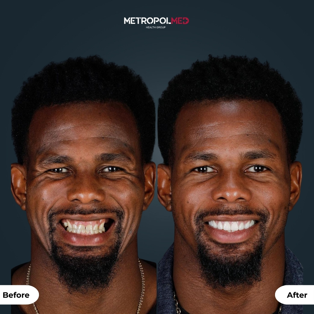 Facettes Dentaires — Metropolmed